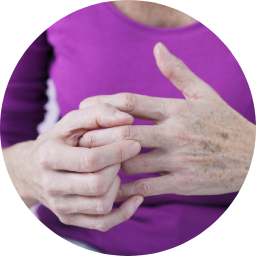 Arthritis
