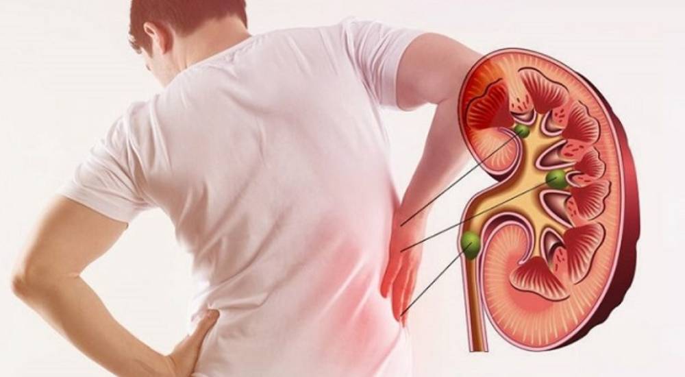 Kidney Stone