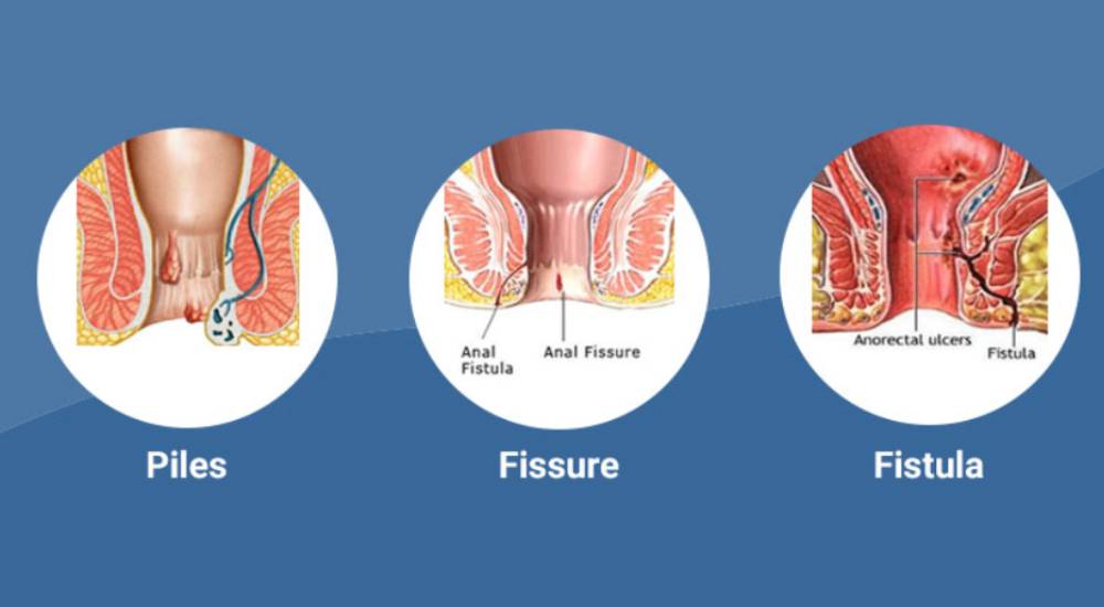 Piles / Fissure / Fistula