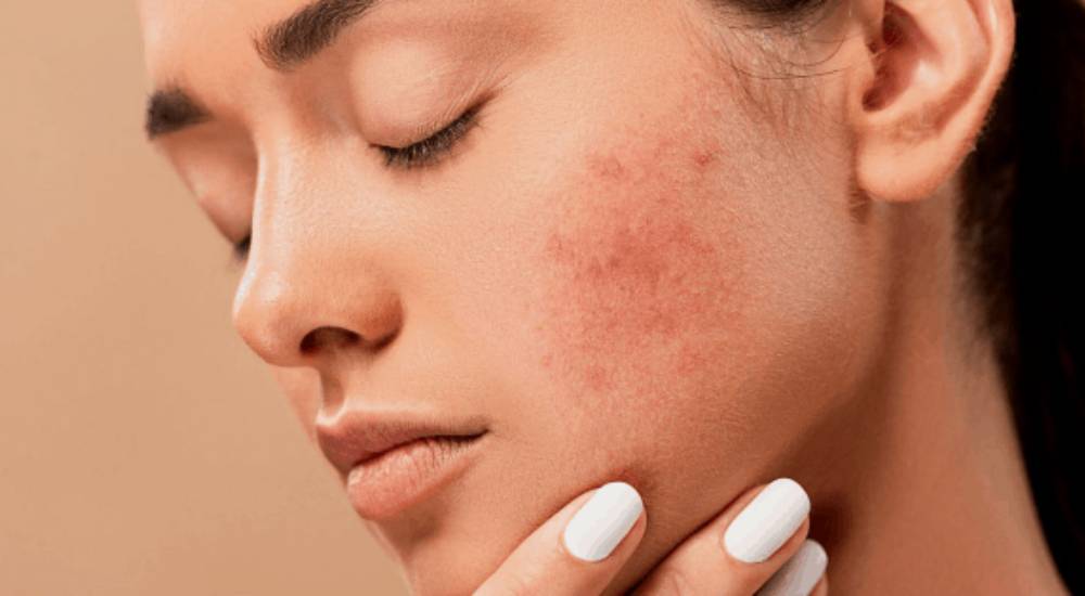 Ayurvedic Treatment For Skin Problems
