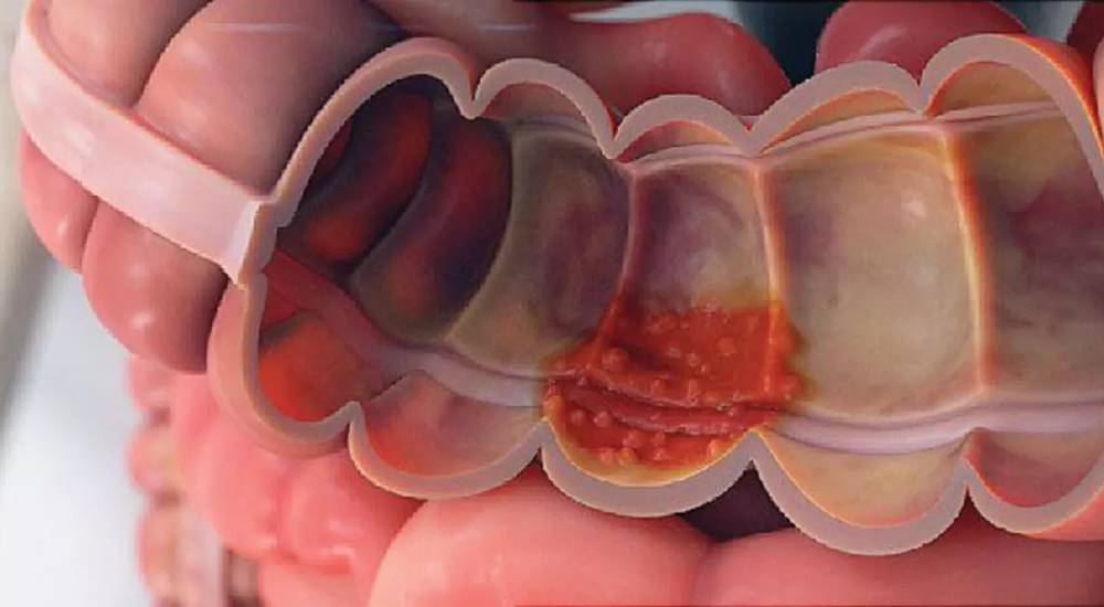 Ulcerative Collitis